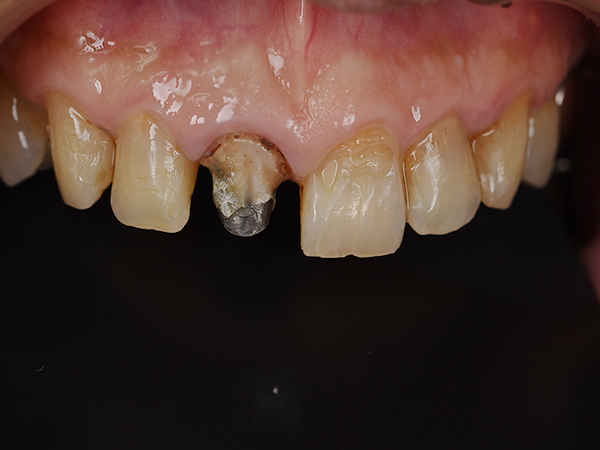 古いクラウンの除去直後、二次虫歯も確認できる