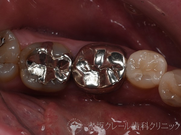 パラジウムインレー(銀歯)。10年以上が経過し劣化している。