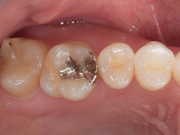 術前　パラジウムインレー(銀歯)。4年が経過しやや劣化し始めている。
