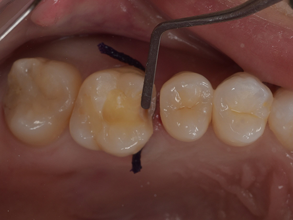 歯肉圧排を行い歯茎が型どりの邪魔にならないよう配慮する。
