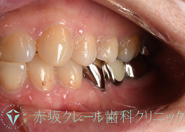 ブリッジと歯の境界にプラークが停滞、二次カリエスが認められる。