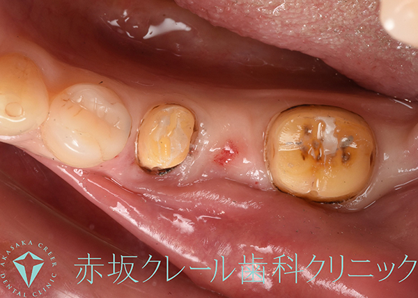 ポンティック（欠損部のダミーの歯）部分の歯茎にも炎症が起きている。