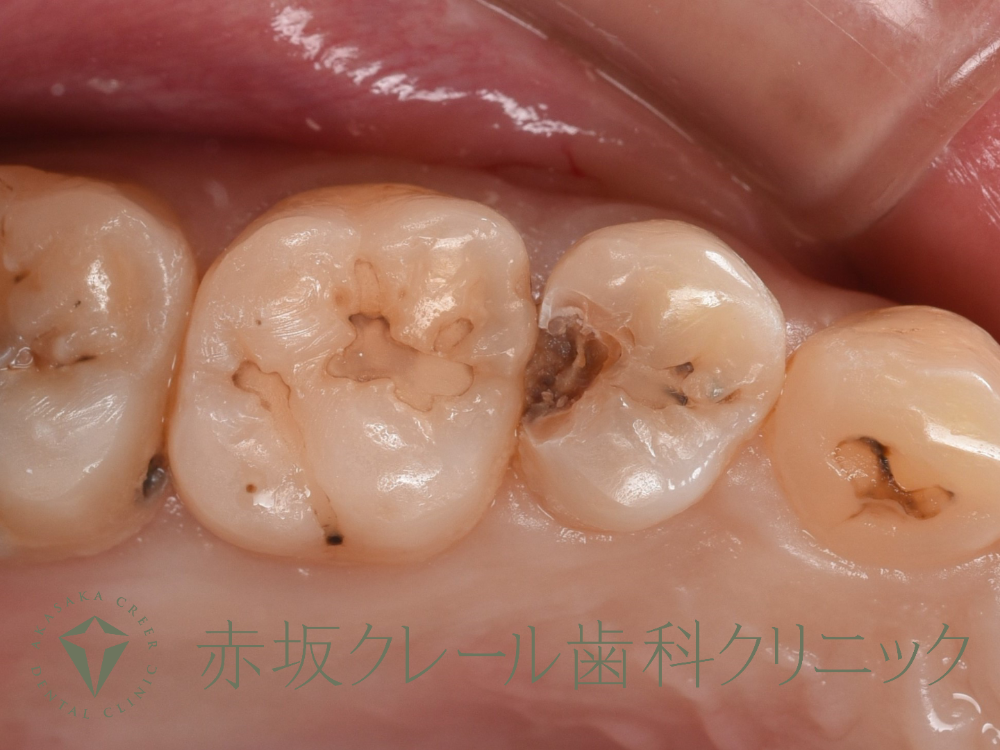 小臼歯に大きなむし歯が確認できる。