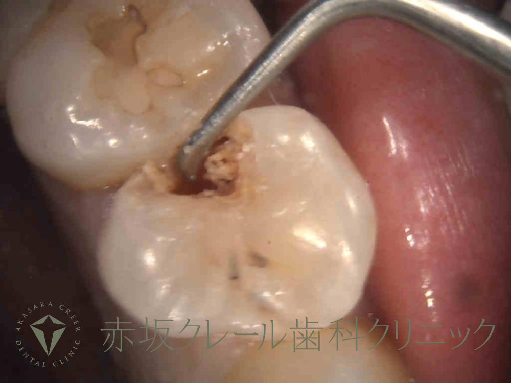 感染した象牙質が、むし歯菌の酸により溶けている。