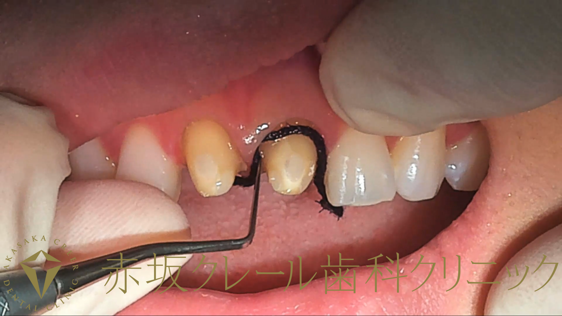 歯肉圧排法で歯茎を押さえてから形態を整える。