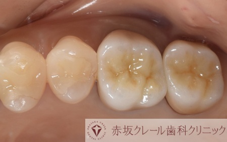 60代女性 奥歯の銀歯を虫歯の再発リスクが低いe.maxインレーと